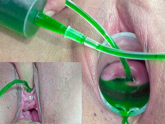 Cervix and Pee Hole Inflation with Injections for Japanese Lesbians