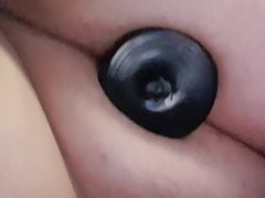 Anal filling with plug