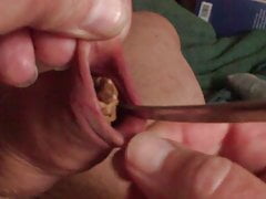 A spoon and a pine cone in foreskin - 3 minutes