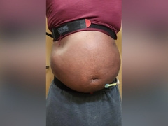 N2o Belly Inflation