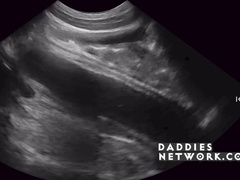 Guts Examination Popped Youngster's Cherry