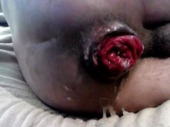 Destroying my ass again episode of anal prolapse series ASS P3 PUMP
